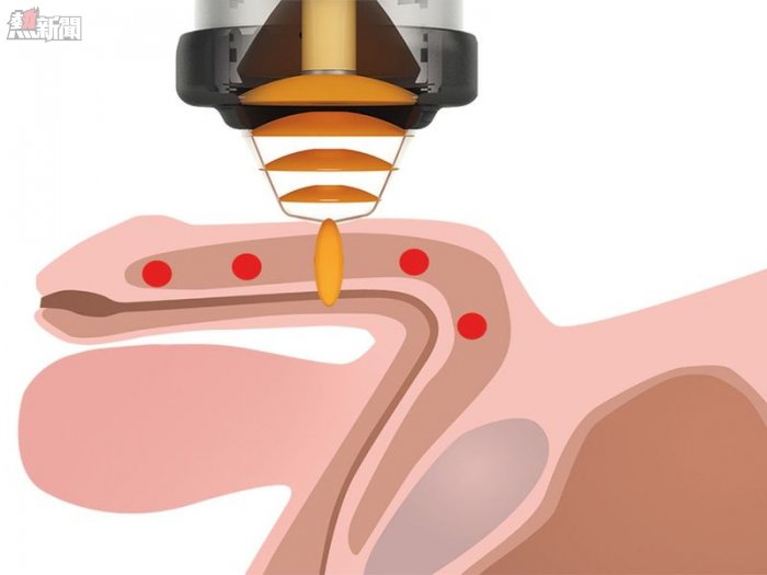 威而鋼也莫法度？　體外震波讓「性」福滿分
