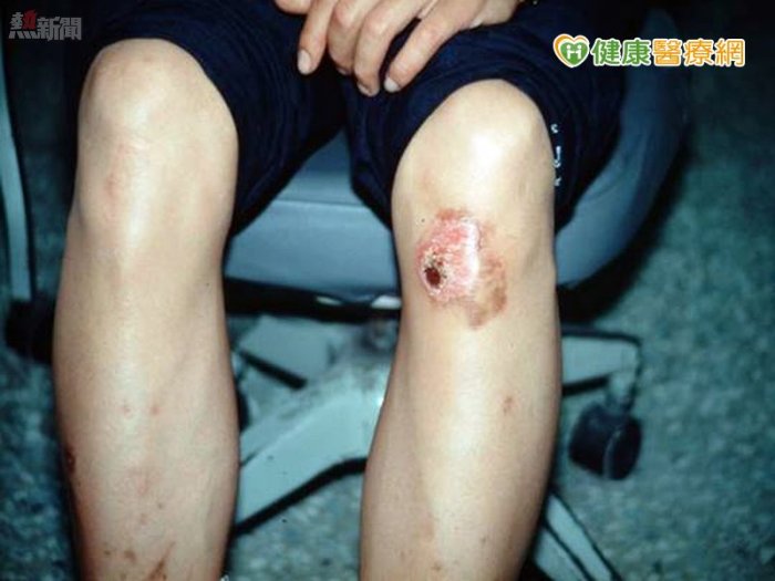 女碩士生做實驗　「化骨水」滴腿險爛