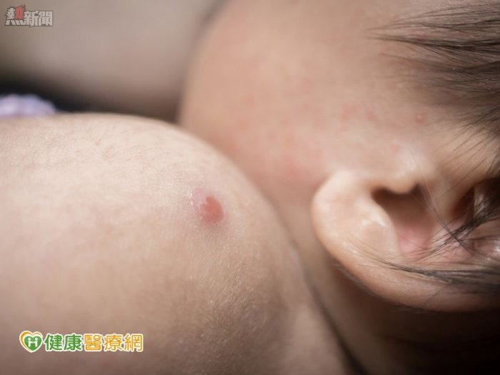 嬰幼兒接種卡介苗　膿瘍三個月未消速就醫
