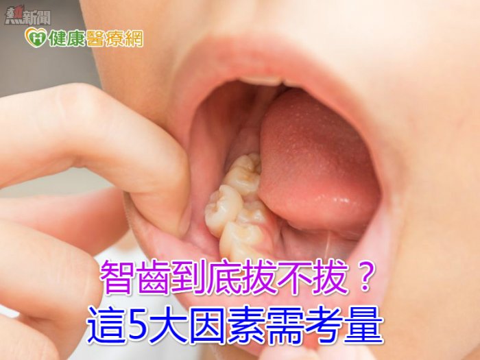 智齒到底拔不拔？　這5大因素需考量